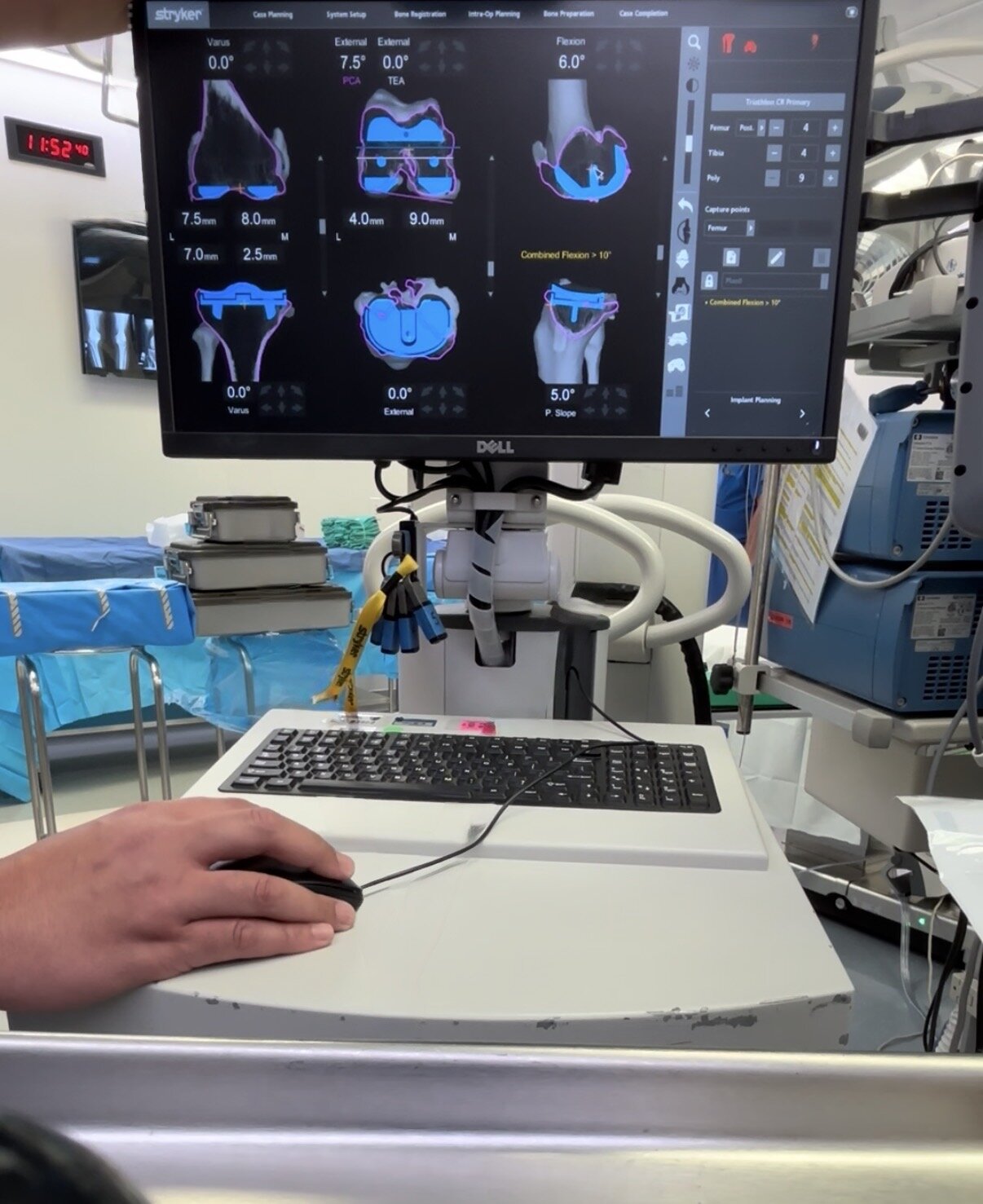 Stryker navigation planning screen in the operating room